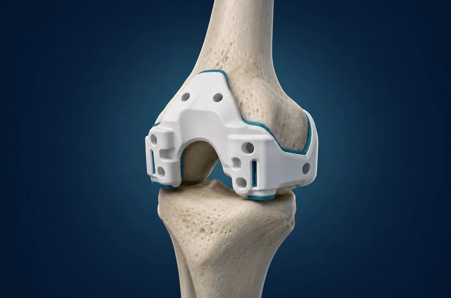 Diz anatomisi üzerinde kişiye özel kesi bloğu